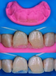 composites stratifiés