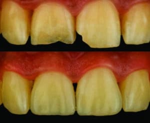 composites stratifiés