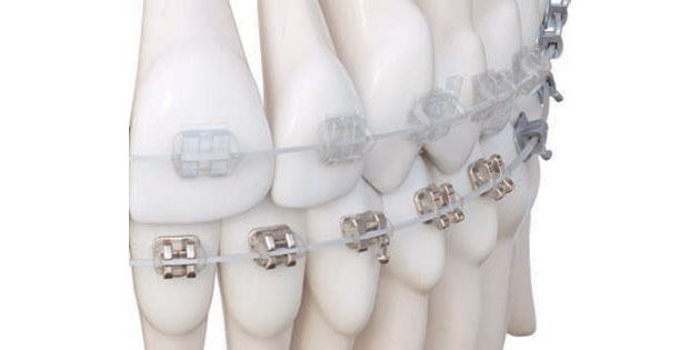 American orthodontics – nouveauté dans la gamme d’arcs : l’arc esthétique iconix se niti