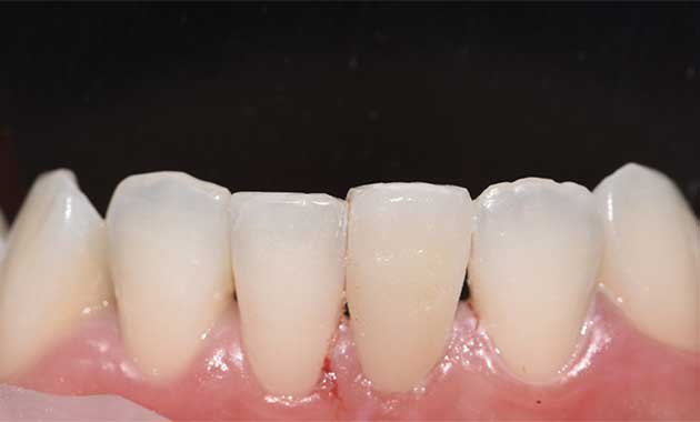 Single dental veneer: an alternative to orthodontics?