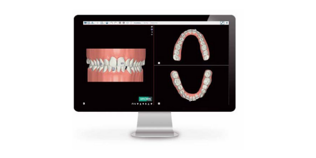 Biotech Dental Smilers : Une technologie exclusive pour une planification maîtrisée.