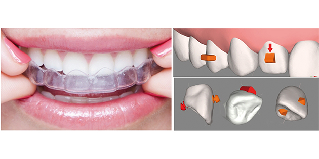 Air Nivol / Odontec – une nouvelle ligne d’aligneurs orthodontiques