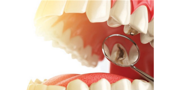 Traitement endodontique