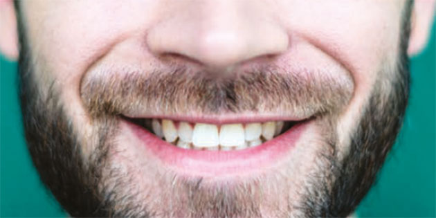 Facettes de Kerr Dental : restauration indirecte à l’aide de facettes céramiques – Dr German Gomez