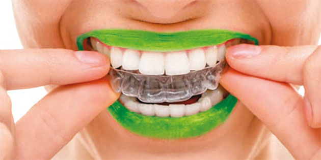 La solution invisible d’alignement dentaire E-Aligner : une gouttière orthodontique 100 % française