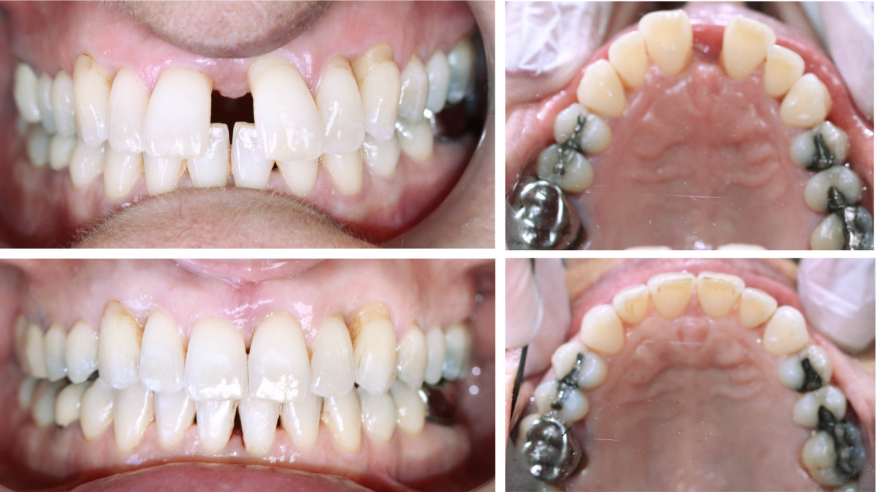 traitement orthodontie par aligner