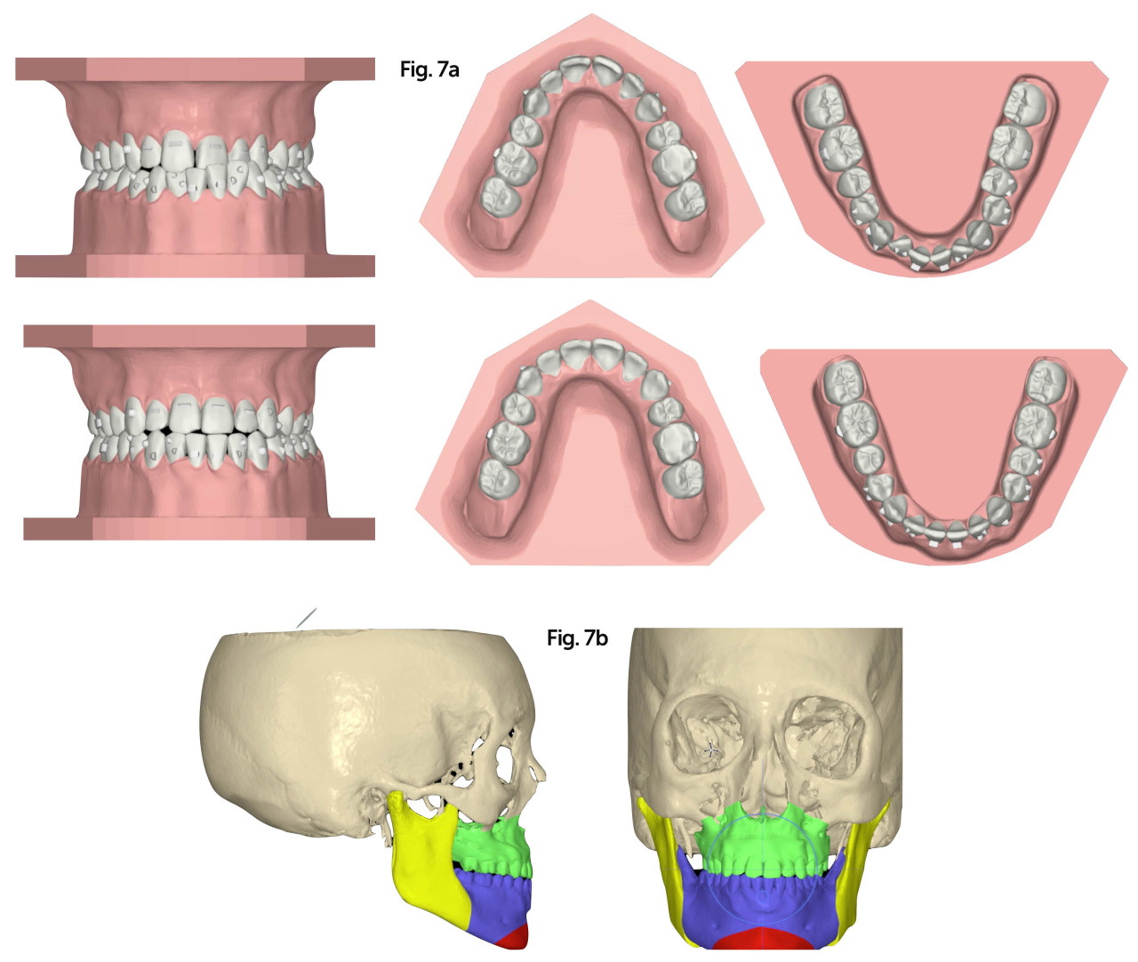 préparation orthodontie