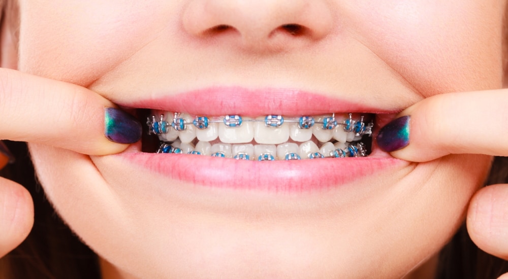 Appareil dentaire la dangereuse tendance des fashion braces