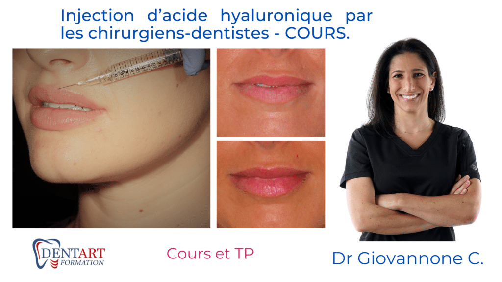 injection dacide hyaluronique par les chirurgiens dentistes cours