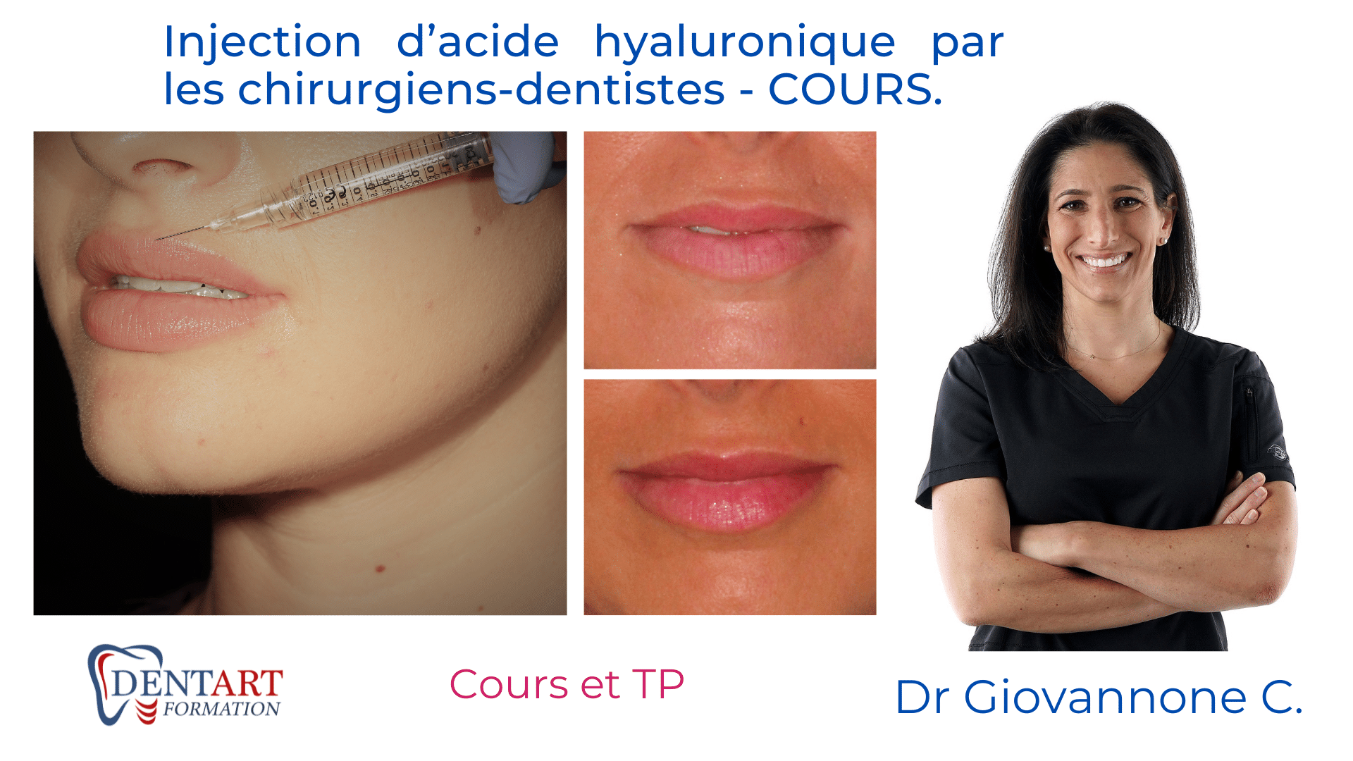 injection dacide hyaluronique par les chirurgiens dentistes cours