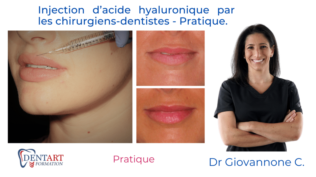 injection dacide hyaluronique par les chirurgiens dentistes pratique