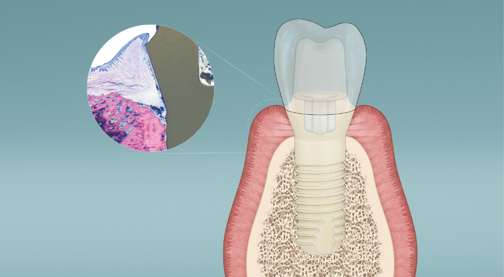 Le Concept Zéro Péri-implantite