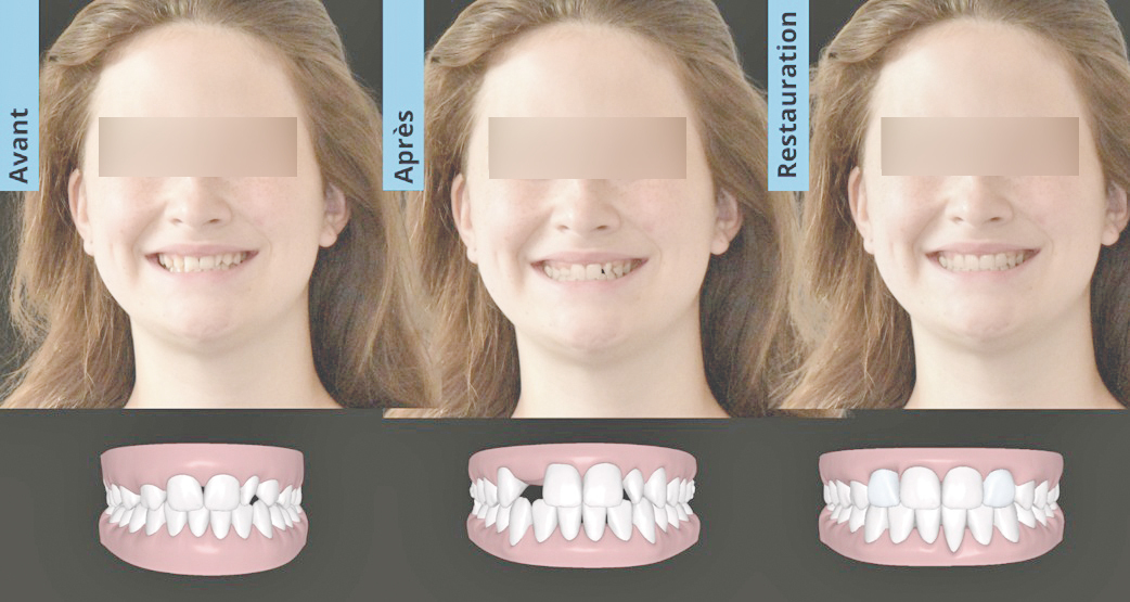 orthodontie rehabilitation sourire