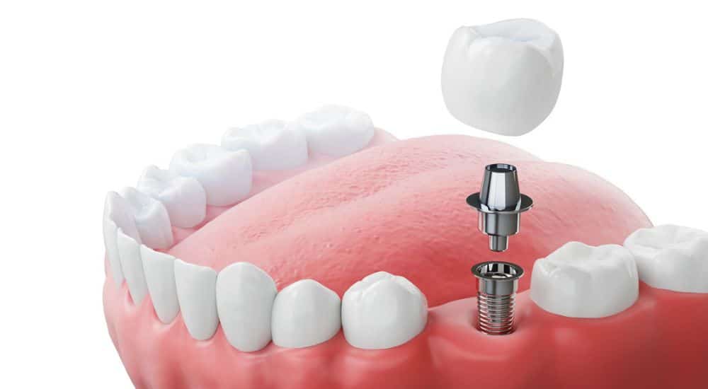 Implantation dentaire, dents avec vis implantaire, illustration 3d implant dentaire unitaire